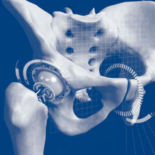 Cirugia artroscopica de cadera